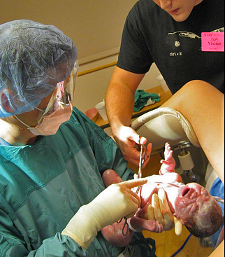 In hospital births, physicians typically clamp and cut the cord moments after birth, and often before giving the baby to the mother.