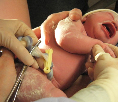 Here you can clearly see the red, oxygen rich blood still in the cord that is about to be severed. This baby did not receive that cord blood that nature intended her to have.